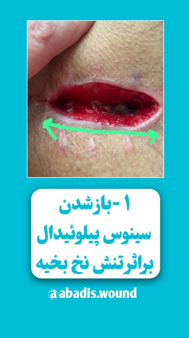 بهترین درمانگر زخم در نارمک