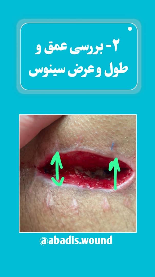 بهترین درمانگر زخم در نارمک