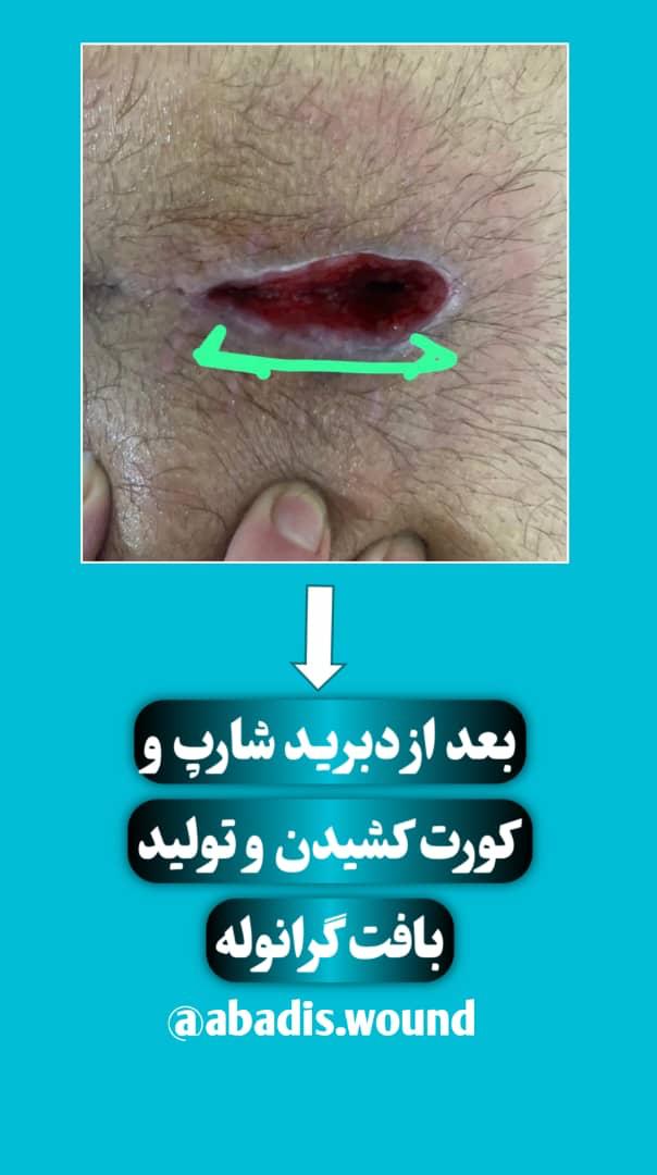 بهترین درمانگر زخم در نارمک