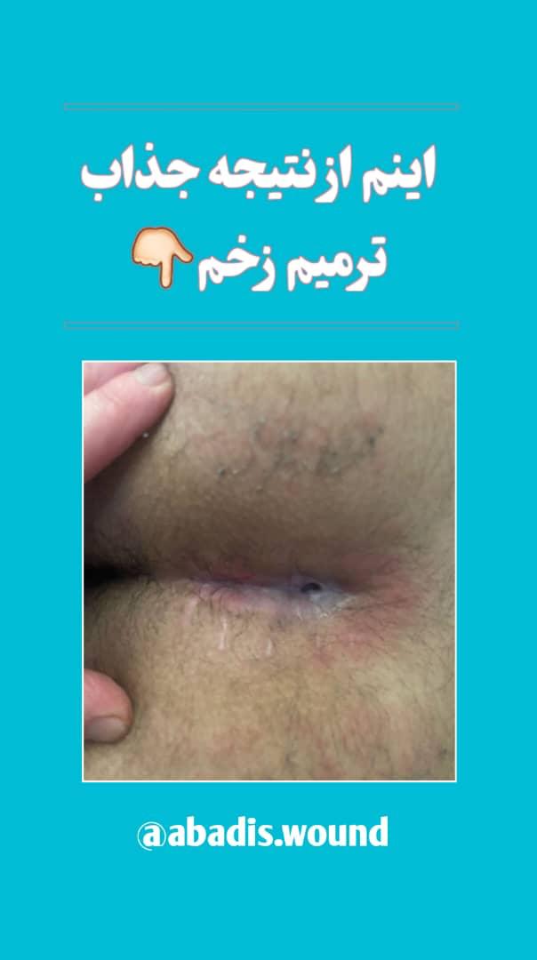 بهترین درمانگر زخم در نارمک