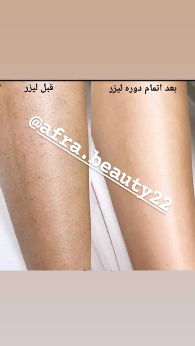 مرکز تخصصی لیزر موهای زائد در چیتگر 