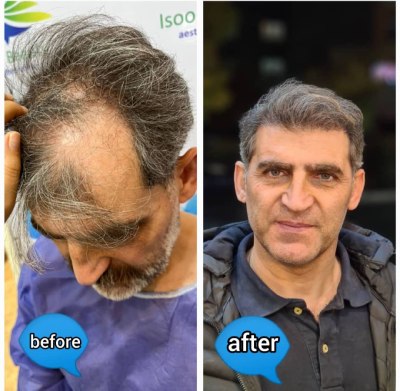 کلینیک تخصصی کاشت مو در شهرک گلستان