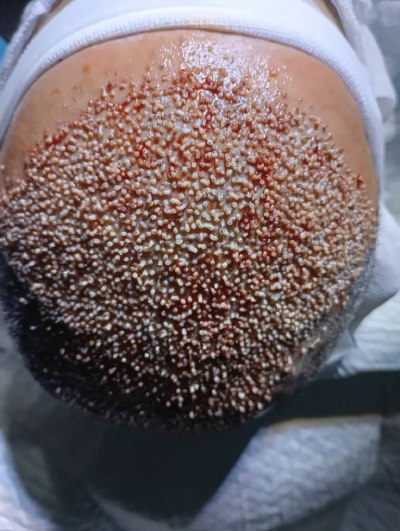 کلینیک تخصصی کاشت مو در شهرک گلستان