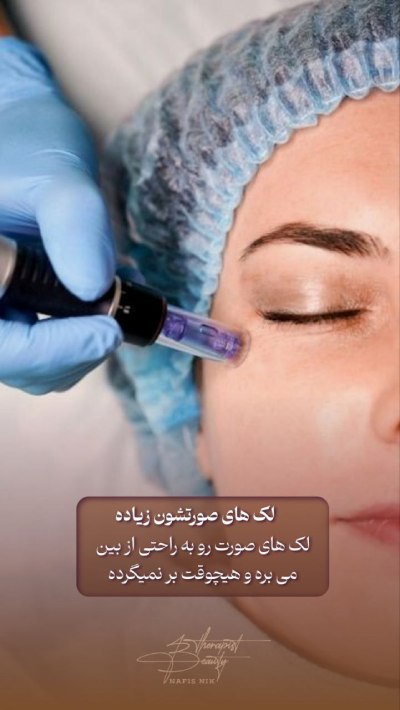 میکرونیدلینگ تخصصی در سعادت آباد
