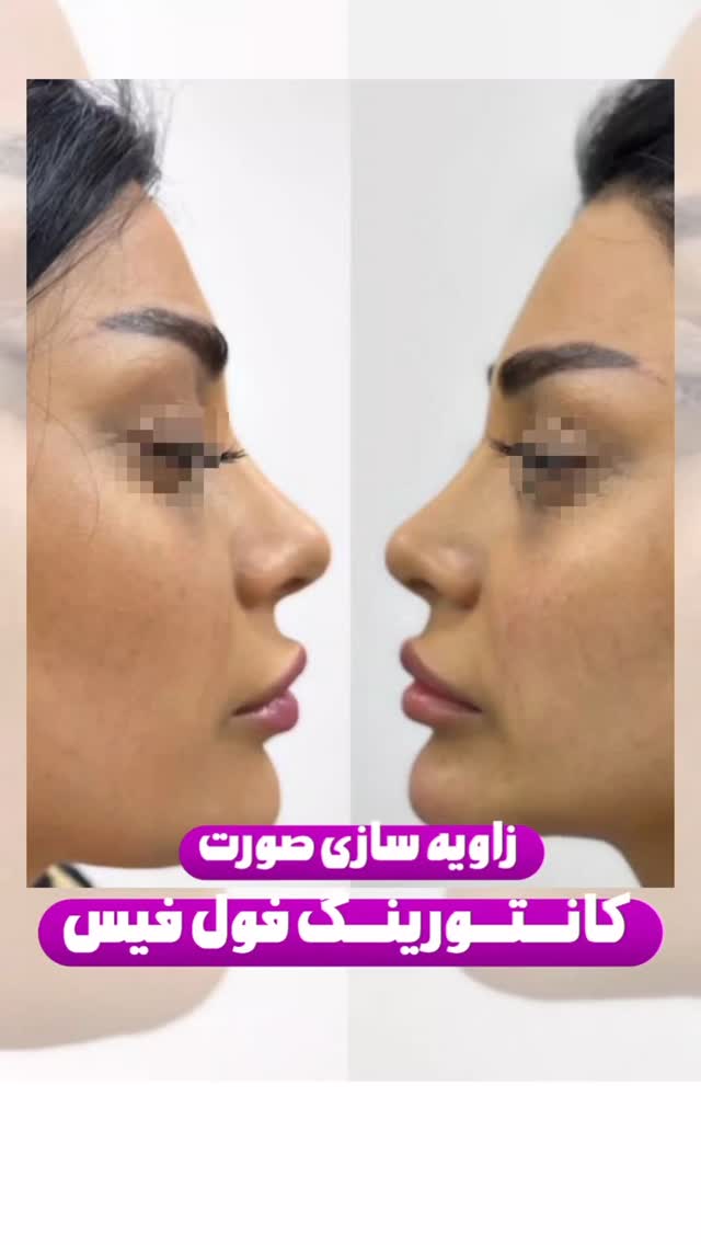 بهترین کلینیک تزریق ژل و بوتاکس در مشیریه