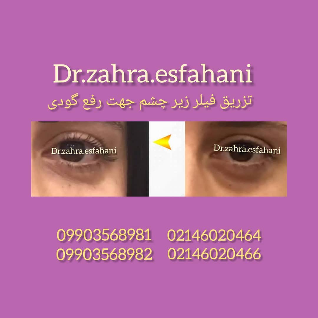 بهترین کلینیک تزریق ژل و بوتاکس در مشیریه