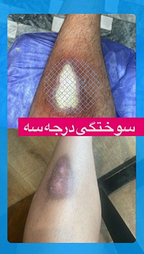 بهترین درمانگر زخم در اشرفی اصفهانی تهران