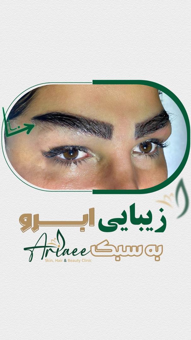 کلینیک کاشت ابرو بدون جراحی در ونک