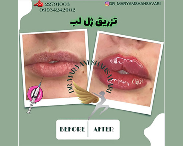 بهترین کلینیک تزریق ژل شمال تهران | خدمات تخصصی و تضمینی