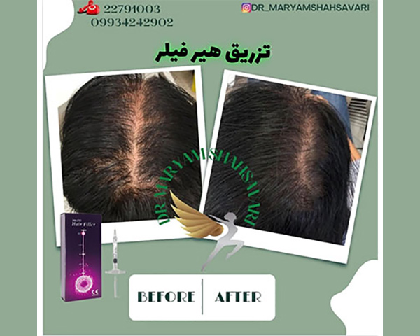 بهترین کلینیک لیزر مو در تهران ⭐ نتایج تضمینی