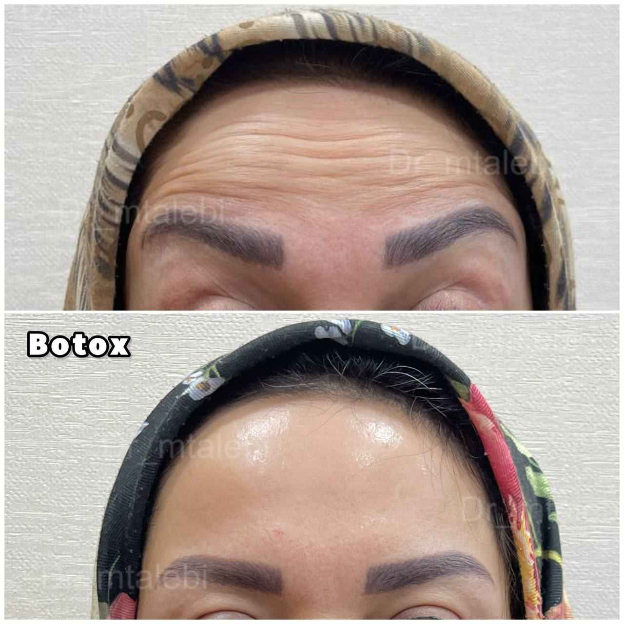 تزریق بوتاکس